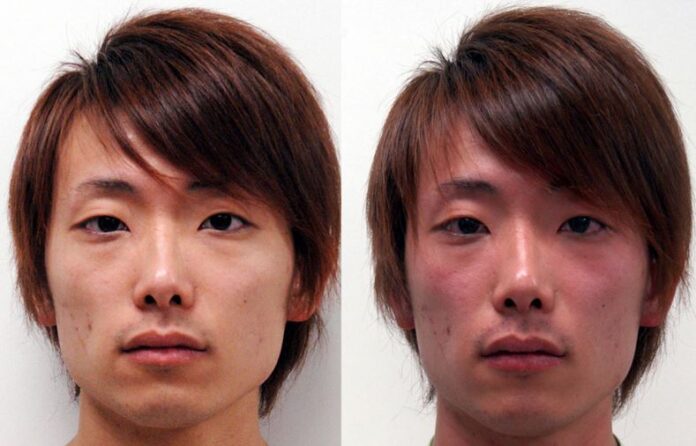 This photo shows the before and after images of someone who experiences Asian glow after consuming alcohol