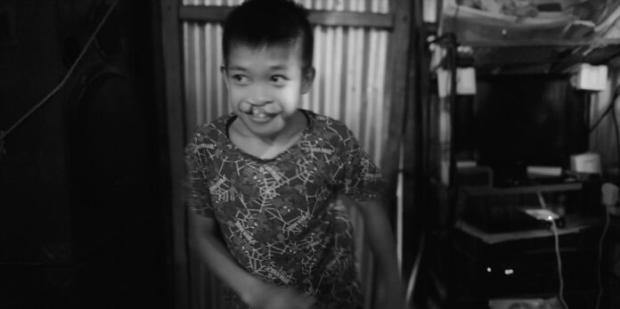 Jary, the cleft affected boy in the documentary Every Day After documentary, movie still, Cleft Lip and Palate, CLP, Cleft Affected, Dave Liu