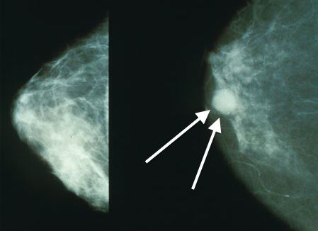 This mammogram shows evidence of breast cancer.